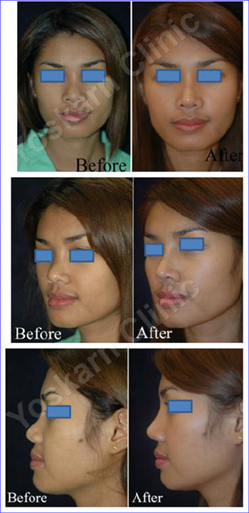 Aesthetic Rhinoplasty Thailand,