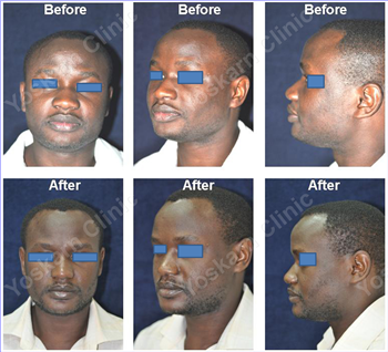 Congenital Nose Deformities Thailand