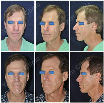 Nasal Obstruction Thailand