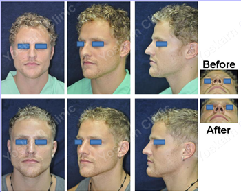 Traumatic Nasal Injury Repair Thailand